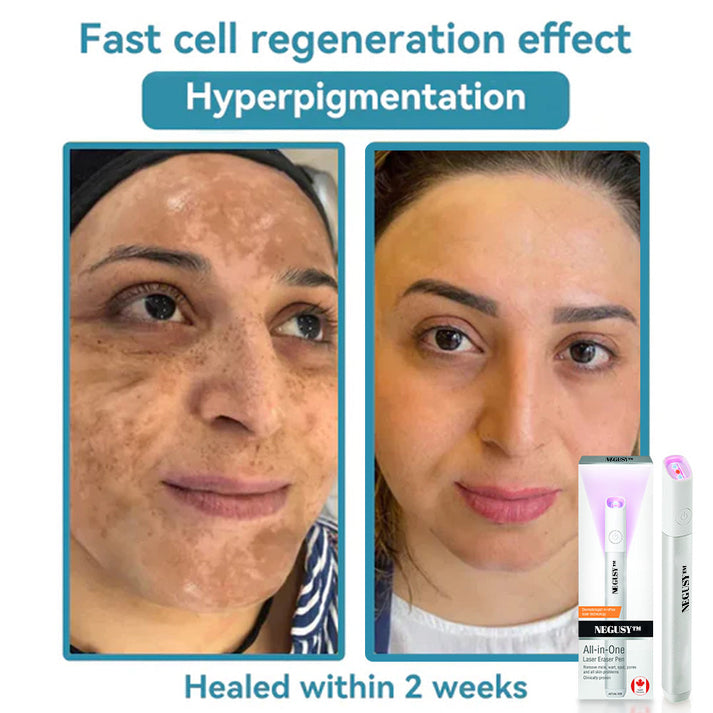 ✨NEGUSY™ All-in-One CO₂ Laser Eraser Pen | Removes Moles, Warts, Skin Flaws & Pigmentation