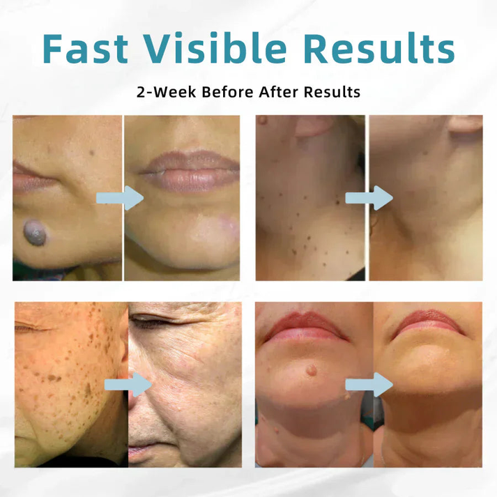 ✨NEGUSY™ All-in-One CO₂ Laser Eraser Pen | Removes Moles, Warts, Skin Flaws & Pigmentation