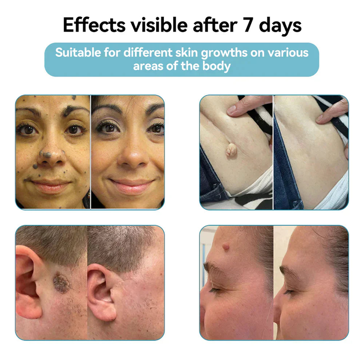 ✨NEGUSY™ All-in-One CO₂ Laser Eraser Pen | Removes Moles, Warts, Skin Flaws & Pigmentation