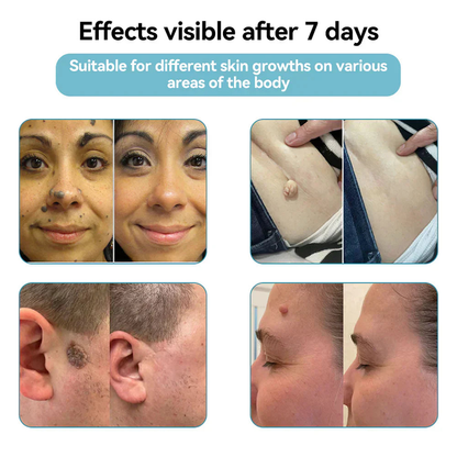✨NEGUSY™ All-in-One CO₂ Laser Eraser Pen | Removes Moles, Warts, Skin Flaws & Pigmentation